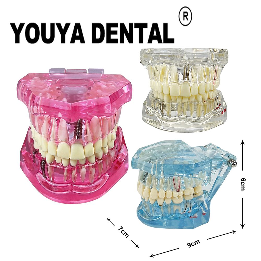 Other Oral Hygiene Teeth Repair Model Disease Teeth Model For Dentist  Student Practice Training Studying Oral Dentistry Tools 230524 From Pong04,  $20.33